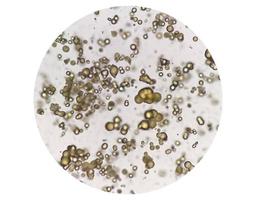 Mikroskopisches Bild der Urinanalyse. anormale Urinuntersuchung. Harnsäurekristalle. foto