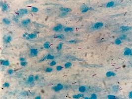 Sputum- oder Schleimabstrich afb-Färbung unter der Mikroskopie, die Macrobacterium tuberculosis-Bakterien oder mtb zeigt foto