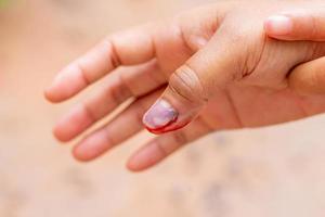 menschlicher finger mit schwarzem gequetschten nagel mit blut foto