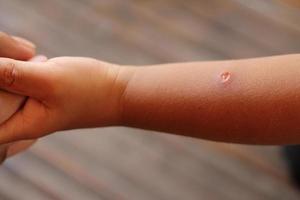 Babyarm mit Wunde nach Insektenstich, Wunde am Arm des Kindes. foto