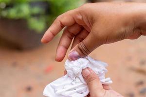 Verletzung des Nagels der rechten Hand und Blutung am rechten Daumen und Blutung im Fingernagel foto