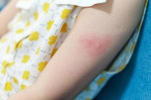 Kleines Mädchen hat eine Hautausschlagallergie, die am Arm juckt und kratzt foto