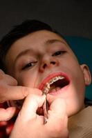 Ein Kieferorthopäde klebt und befestigt Zahnspangen an den oberen Zähnen eines Schuljungen und richtet die Zähne mit Zahnspangen aus. foto