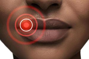 Lippen einer schwarzen Frau, die vom Herpes-simplex-Virus betroffen sind foto