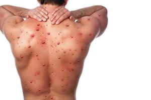 männlicher Rücken, der aufgrund von Affenpocken oder einer anderen Virusinfektion von Blasenbildung betroffen ist foto