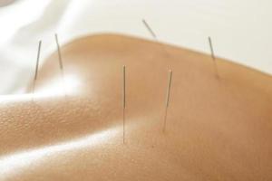 weiblicher Rücken mit Stahlnadeln während des Verfahrens der Akupunkturtherapie foto