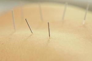 weiblicher Rücken mit Stahlnadeln während des Verfahrens der Akupunkturtherapie