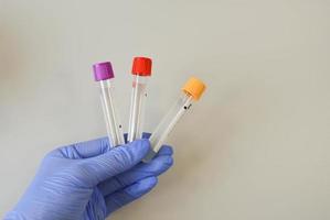 krankenschwester, die blutteströhrchen mit ergebnis-coronavirus-test hält. 2019-ncov Virusdiagnoselabore foto