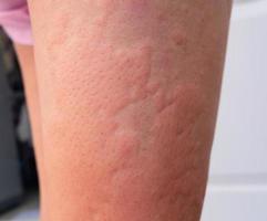 Allergieausschlag bei Dermatitisproblemen. Hautproblem durch Arzneimittelallergie. foto