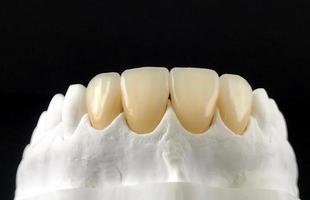 Zahnveneers und Kronen im Gipsmodell für die Behandlung und neues Lächeln. Zirkonkronen mit Vollporzellan. zahnprothetisches Labor. Keramikzähne - zahntechnische Arbeit foto