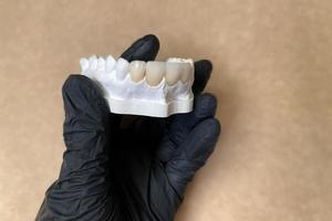 Gipsmodell mit falschen Keramik- oder Porzellanzähnen in der Hand des Zahnarztes in schwarzem Handschuh. Zahnersatz und Zahngesundheit. selektiver Fokus, Nahaufnahme. Zahnprothesen und Keramikabdeckungen für Zähne foto
