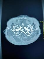 mra und mrv der Gehirngeschichte weiblich, vorgestellt mit intrakranieller Blutung foto