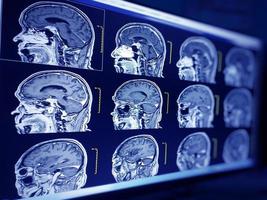 Magnetresonanztomographie-Gehirn eines menschlichen Gehirns mit Verdacht auf Zerebropathie foto