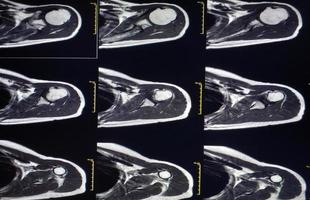 Magnetresonanztomographie des Schultergelenks foto