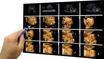 Hand Arzt hält einen Stift auf Bild Ultraschall 3d -4d des Babys im Mutterleib. foto