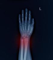 Röntgenfrakturradius des linken Handgelenks. foto