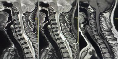 MRI-C-Wirbelsäule zeigt eine Masse am linken posterolateralen Aspekt des Wirbelkanals c4-5, die eine gemischte solide-zystische Masse mit heterogener Verstärkung zeigt foto