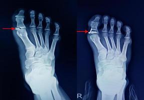 Röntgen-Fußfraktur proximales Fingerglied und chirurgische Fixierung der Miniplatte und Schrauben foto