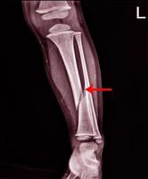 röntgen linkes bein ap lat fraktur tibia. foto
