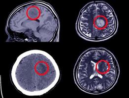 CT-Scan des Gehirns mit intrazerebraler Blutung - axiale Ansicht foto