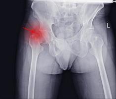 röntgen Sie beide Hüften und finden Sie einen Bruch am Oberschenkelknochen. foto