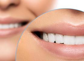 weiblicher Mund. Vergleich vor und nach der Zahnaufhellung foto