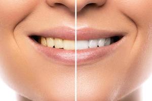 weiblicher Mund. Vergleich vor und nach der Zahnaufhellung foto