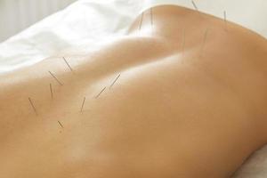 weiblicher Rücken mit Stahlnadeln während des Verfahrens der Akupunkturtherapie foto