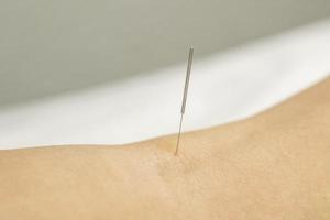 weibliches Bein mit Stahlnadeln während der Akupunkturtherapie foto