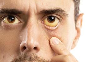 gelbliche Augen sind ein Zeichen für Leberprobleme, Virusinfektionen oder andere Krankheiten foto