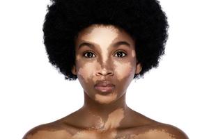 schöne schwarze Frau mit Vitiligo-Hauterkrankung foto