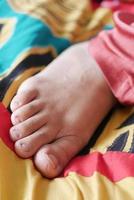 Nahaufnahme von Frauen infizierte Füße Finger auf dem Bett, foto