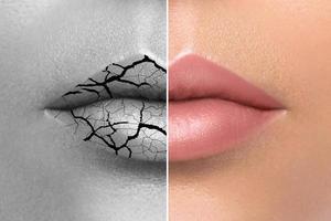 rissige weibliche Lippen nach der Behandlung foto