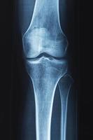 Röntgenaufnahme des menschlichen Knies. Probleme mit Knochen oder Gelenken. foto