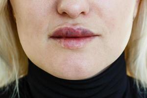 Nahaufnahme einer schönen Frau, die eine Schönheitsinjektion für die Lippen macht foto