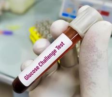 Blutprobe für den Glukose-Provokationstest, auch bekannt als einstündiger Glukosetoleranztest. Screening-Test für Schwangerschaftsdiabetes, der sich während der Schwangerschaft entwickelt. foto
