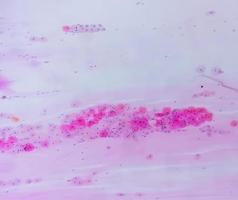 Pap-Abstrich unter Mikroskopie, der einen entzündlichen Abstrich mit HPV-bedingten Veränderungen zeigt. Gebärmutterhalskrebs. sc foto