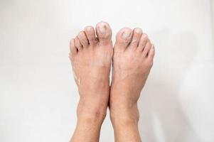 Nahaufnahme von Abblättern und rissigem Fuß aufgrund einer allergischen chemischen Reaktion. foto