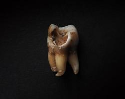 Makroaufnahme eines verfallenen Zahns bis zur Wurzel nach der Extraktion des Zahnarztes. foto