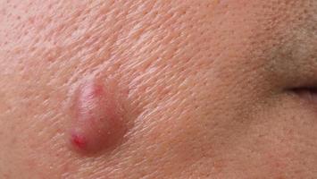 bakterielle Hautinfektion. großer Akne-Zysten-Abszess oder Geschwür geschwollener Bereich im Gesichtshautgewebe. mit Ansammlung von Eiter und Blut. Makroaufnahme von Akne oder Dermatitis in der Nähe des Mundes im Gesicht. Hautpflege. foto