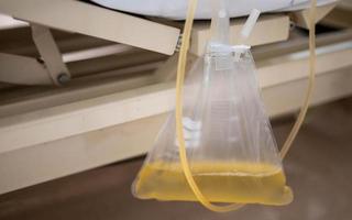 Der Urin- oder Urinkatheterbeutel hängt im Krankenhaus unter dem Patientenbett. foto