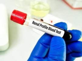 Nieren- Profil Blut Prüfung zum das Diagnose von Nieren- oder Niere Krankheit. foto