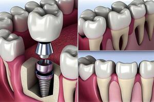 Installation von ein Metall Stift zum ein Dental implantieren Illustration generativ ai foto