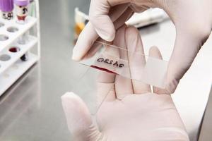 Wissenschaftler vorbereiten ein Knochen Mark Abstrich im das Labor. Blut Abstrich. foto