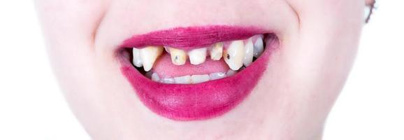 weiblich Lächeln mit Nein Zähne foto