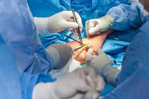 Gruppe von Chirurgen durchführen ein Ellbogen Chirurgie foto
