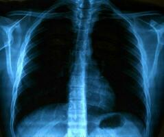 Röntgen Bild von Mensch gesund Truhe foto