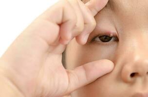 schließen oben von asiatisch wenig Mädchen einer Auge Infektion isoliert foto