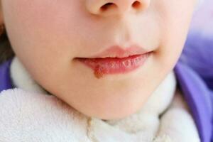 Herpes auf Lippen von Kind. Behandlung Salbe. foto