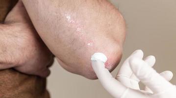 Ein Dermatologe in Handschuhen trägt eine therapeutische Salbe auf die betroffene Haut eines Patienten mit Psoriasis auf foto